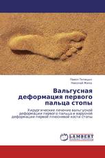Вальгусная деформация первого пальца стопы