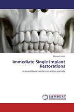 Immediate Single Implant Restorations