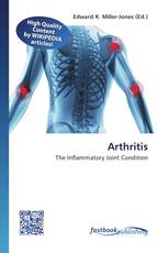 Arthritis