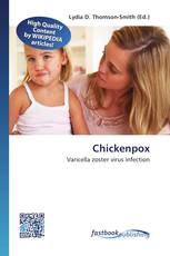 Chickenpox