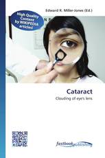 Cataract