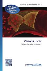 Venous ulcer