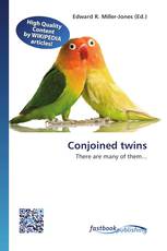 Conjoined twins