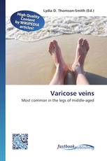 Varicose veins