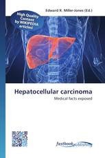 Hepatocellular carcinoma