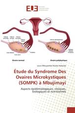 Étude du Syndrome Des Ovaires Microkystiques (SOMPK) à Mbujimayi