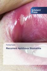 Recurrent Aphthous Stomatitis