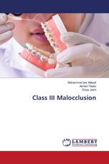 Class III Malocclusion