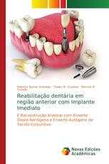 Reabilitação dentária em região anterior com Implante Imediato
