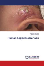 Human Lagochilascariasis