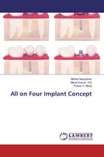 All on Four Implant Concept