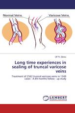 Long time experiences in sealing of truncal varicose veins