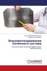 Эндопротезирование коленного сустава