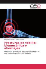 Fracturas de tobillo: biomecánica y abordajes