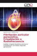 Fibrilación auricular paroxística. Crioablación o Radiofrecuencia