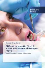 SNPs at Interleukin (IL)-1β +3954 and Vitamin D Receptor (VDR)