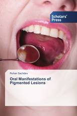 Oral Manifestations of Pigmented Lesions