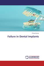 Failure in Dental Implants