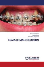 CLASS III MALOCCLUSION