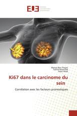 Ki67 dans le carcinome du sein