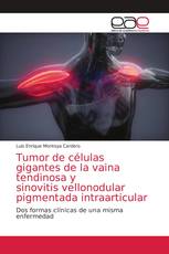 Tumor de células gigantes de la vaina tendinosa y sinovitis vellonodular pigmentada intraarticular