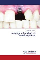 Immediate Loading of Dental Implants