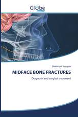 MIDFACE BONE FRACTURES