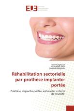 Réhabilitation sectorielle par prothèse implanto-portée