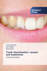 Tooth discoloration: causes and treatments