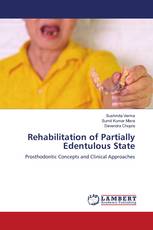 Rehabilitation of Partially Edentulous State