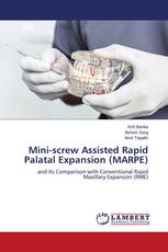 Mini-screw Assisted Rapid Palatal Expansion (MARPE)