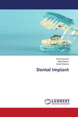 Dental Implant