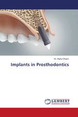 Implants in Prosthodontics