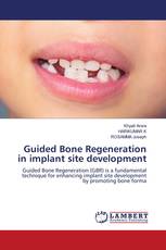 Guided Bone Regeneration in implant site development