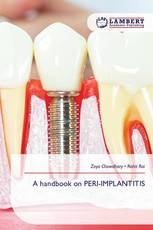 A handbook on PERI-IMPLANTITIS