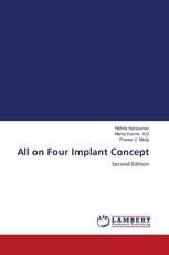 All on Four Implant Concept