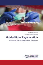 Guided Bone Regeneration