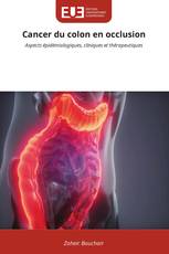 Cancer du colon en occlusion