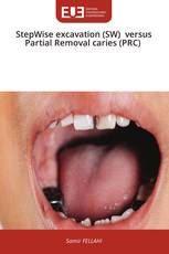StepWise excavation (SW) versus Partial Removal caries (PRC)