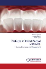 Failures in Fixed Partial Denture