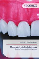 Microneedling in Periodontology