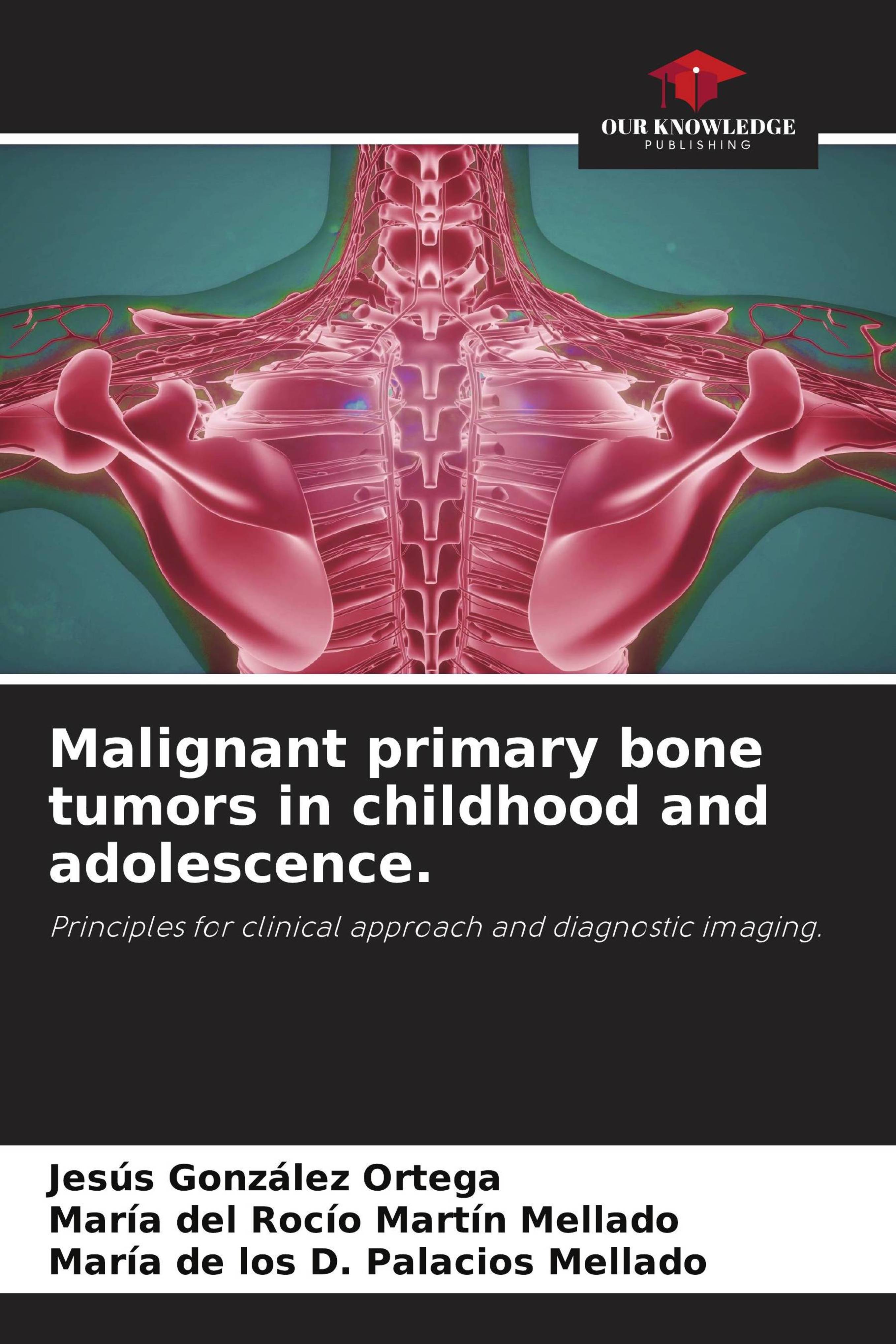 Buy Malignant primary bone tumors in childhood and adolescence.