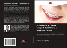 Couverture de Orthodontie accélérée : L'impact du LPRF sur la rétraction canine