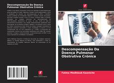 Descompensação Da Doença Pulmonar Obstrutiva Crónica的封面