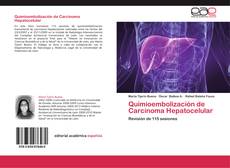 Quimioembolización de Carcinoma Hepatocelular的封面