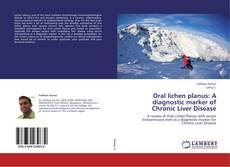 Bookcover of Oral lichen planus: A diagnostic marker of Chronic Liver Disease