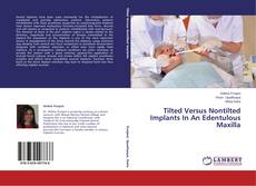 Couverture de Tilted Versus Nontilted Implants In An Edentulous Maxilla