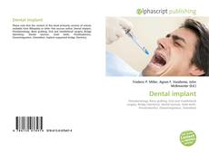 Borítókép a  Dental implant - hoz