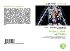 Bookcover of Benign prostatic hyperplasia