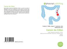 Bookcover of Cancer du Côlon